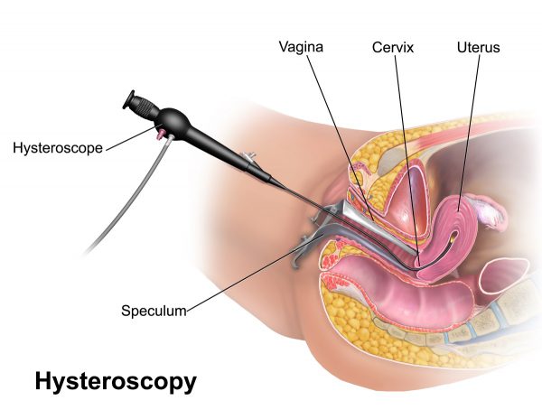 Hysteroscopy and Polypectomy in Iran