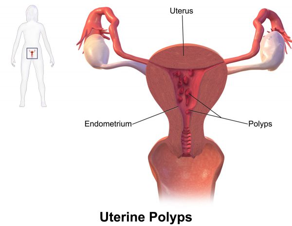 Hysteroscopy and Polypectomy cost