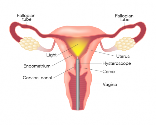 Hysteroscopy full image e1598170035591