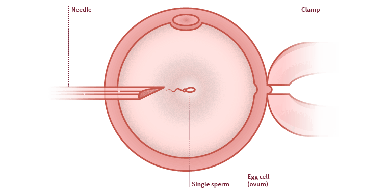 ICSI Intracytoplasmic sperm injection