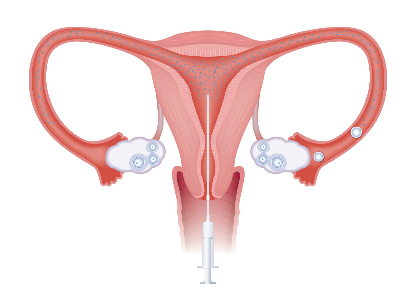 iui-intrauterine-insemination-2