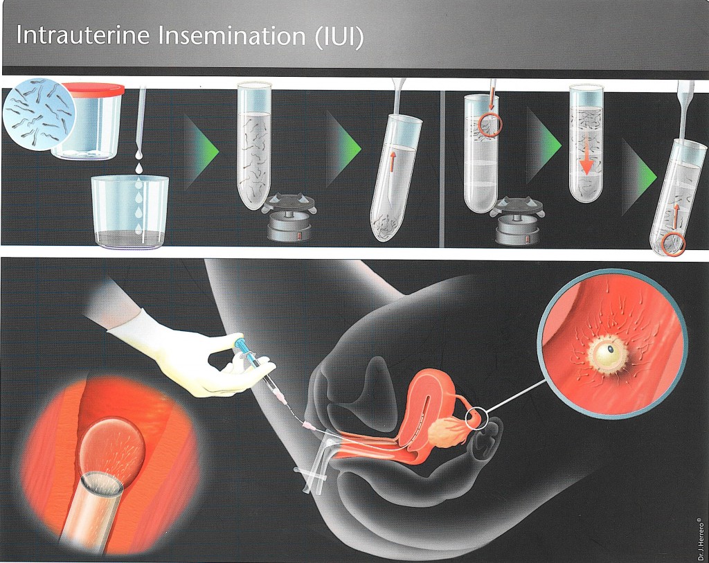 iui-intrauterine-insemination-3