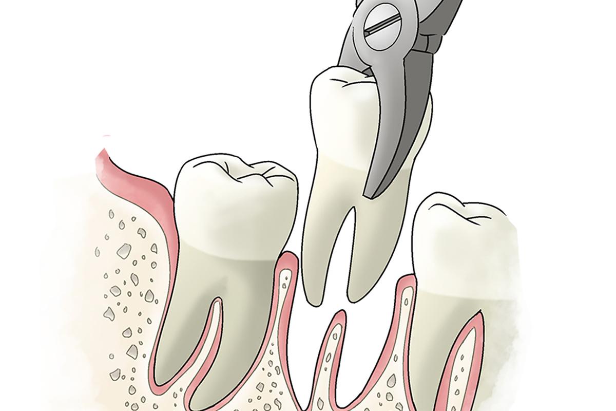 impacted-tooth-extract-6