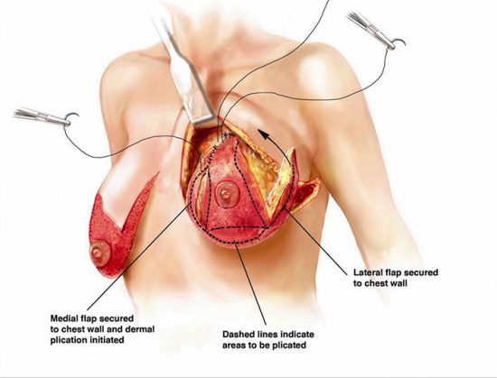 Breast Lift Mastopexy