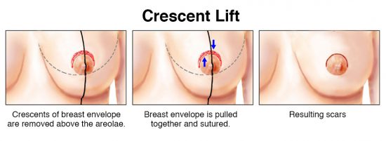 Breast Lift Mastopexy