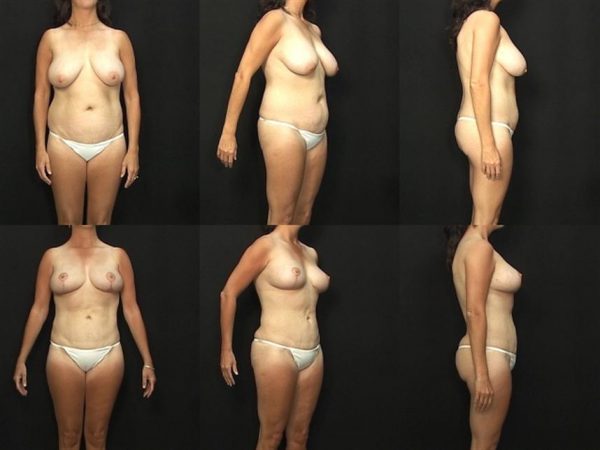 Breast Lift Mastopexy