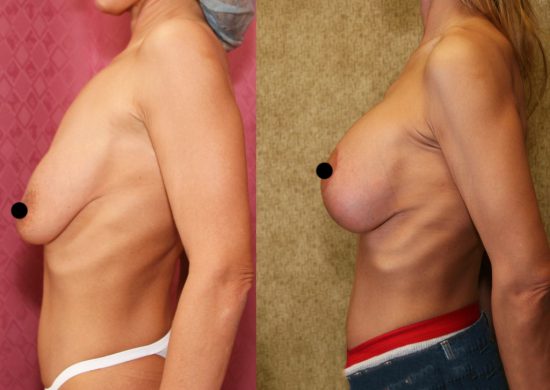 Breast Lift Mastopexy