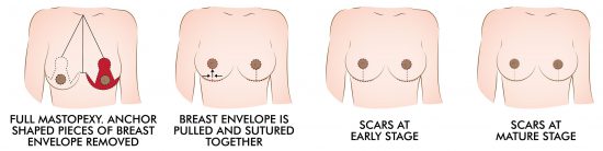 Breast Lift Mastopexy