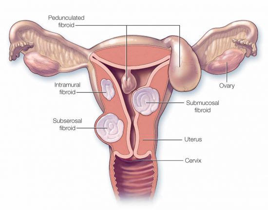 Myomectomy 5 e1598170152181