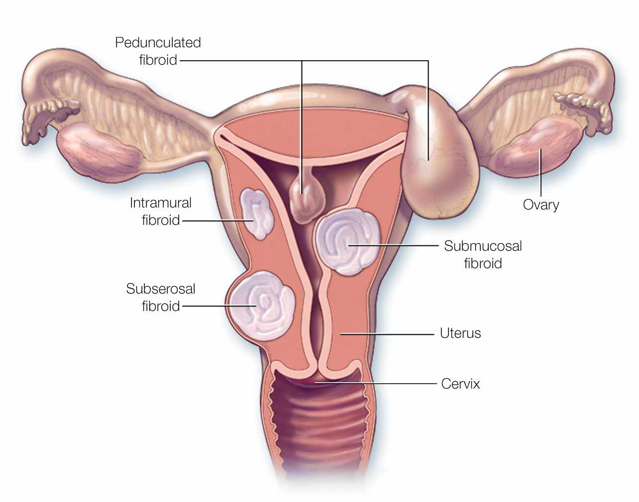 myomectomy-5