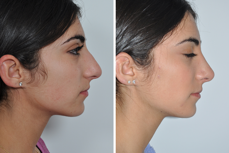 rhinoplasty-without-surgery