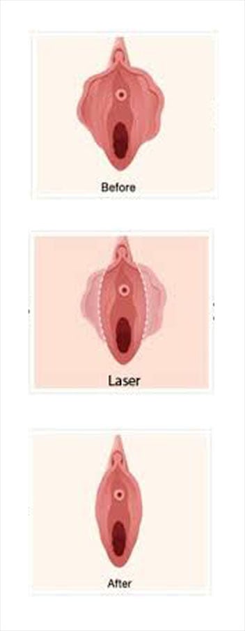 Labiaplasty in Iran