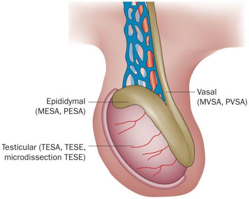 TESE testicular sperm extraction e1598169928233