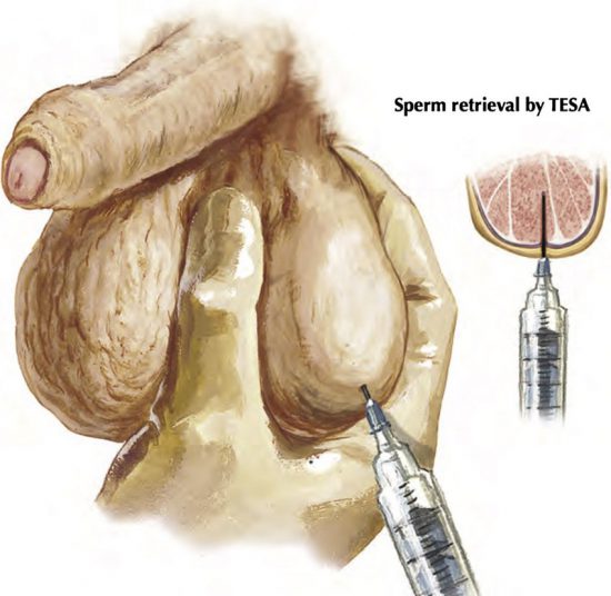 Testis sperm aspiration TESA is performed by needle biopsy Adapted with permission e1598169893582