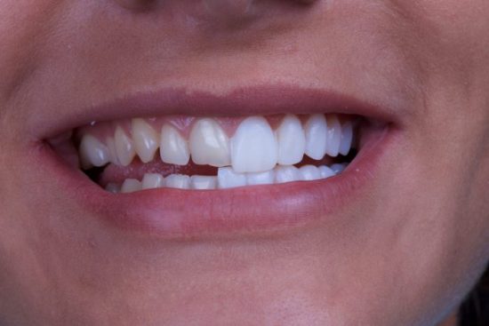 What Are the Advantages of Dental Veneers e1598171914888