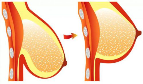 Breast Lift Mastopexy