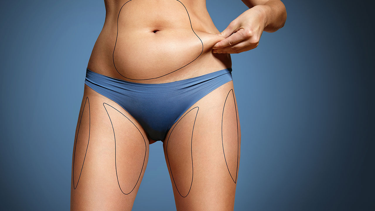 abdominal-liposuction-2