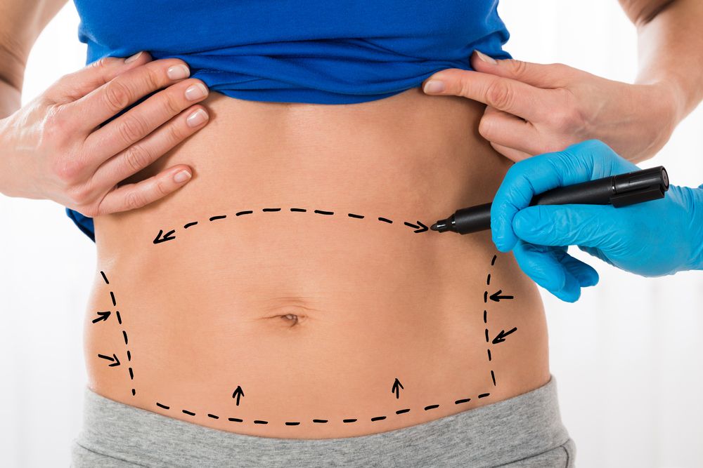 abdominal-liposuction-4-2