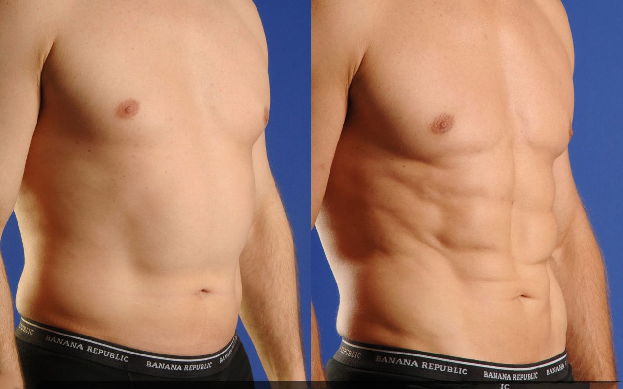 What Is Liposuction Surgery Cost