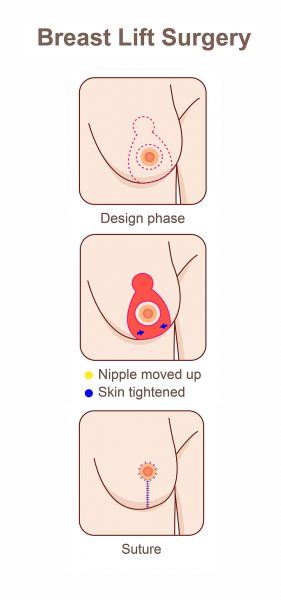 Breast Lift Mastopexy