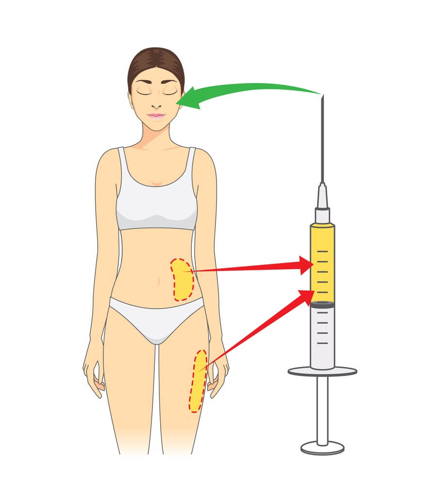 fat grafting or fat injection fat transfer