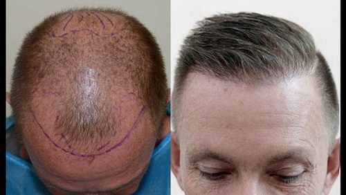 Haircut after Hair transplant | How can I get a haircut after hair  transplant?