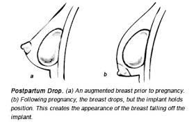 Breast Lift Mastopexy