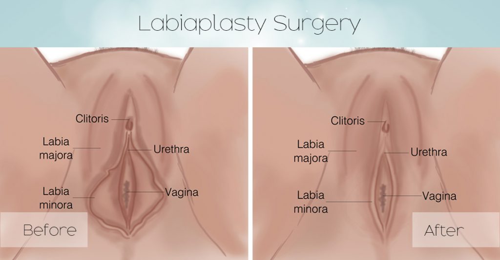Post Op Vaginoplasty