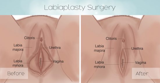 labiaplasty Surgery e1598169871159