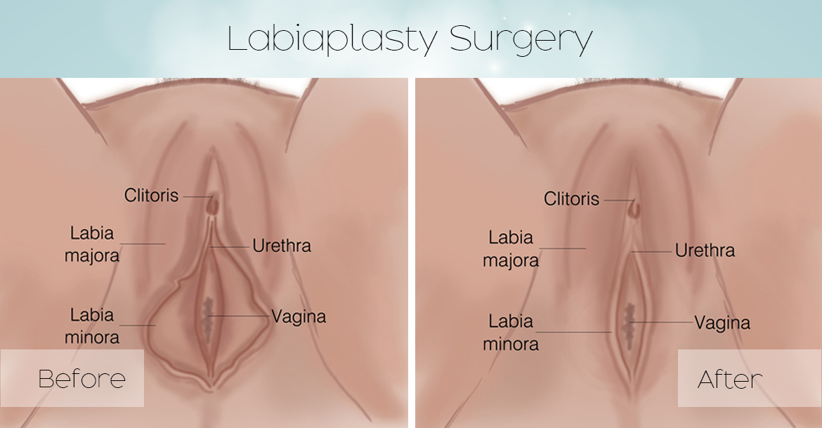 labiaplasty_surgery