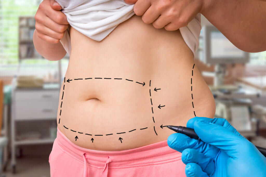 liposuction-in-iran