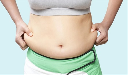 Liposuction in Obese