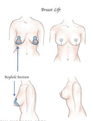 Breast Lift Mastopexy