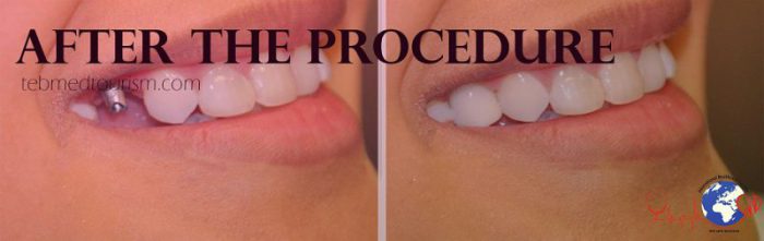 After the procedure e1598168020749