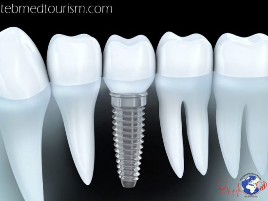 Dental Implants