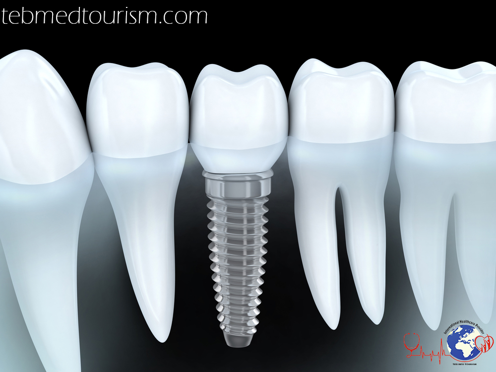 Everything about Dental Implant benefits