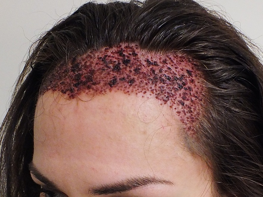 female-hair-transplant-after-surgery-side-view-418921423