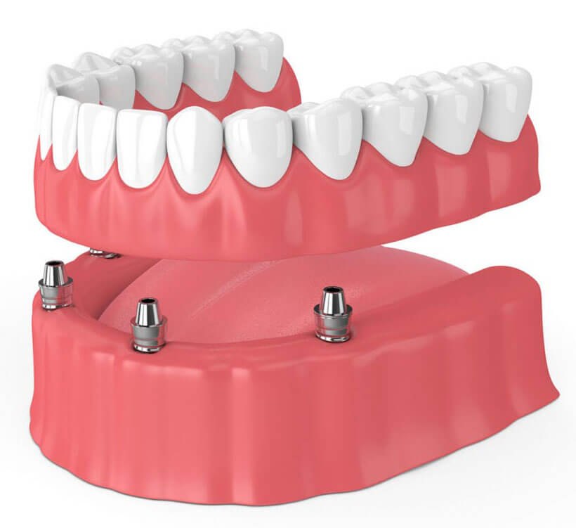 Dental Implant