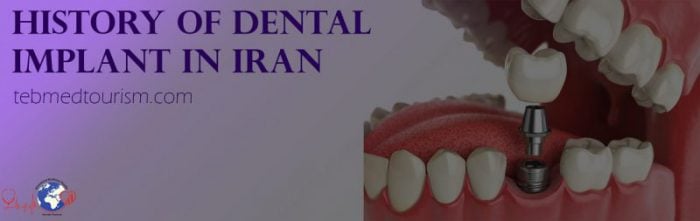 Dental Implant