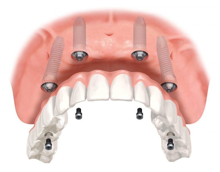 all-on-four-implant-768x601