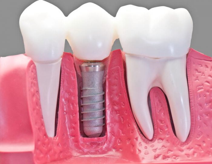 Dental implants