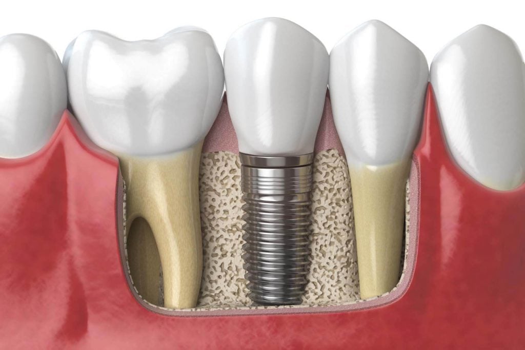 Dental implants