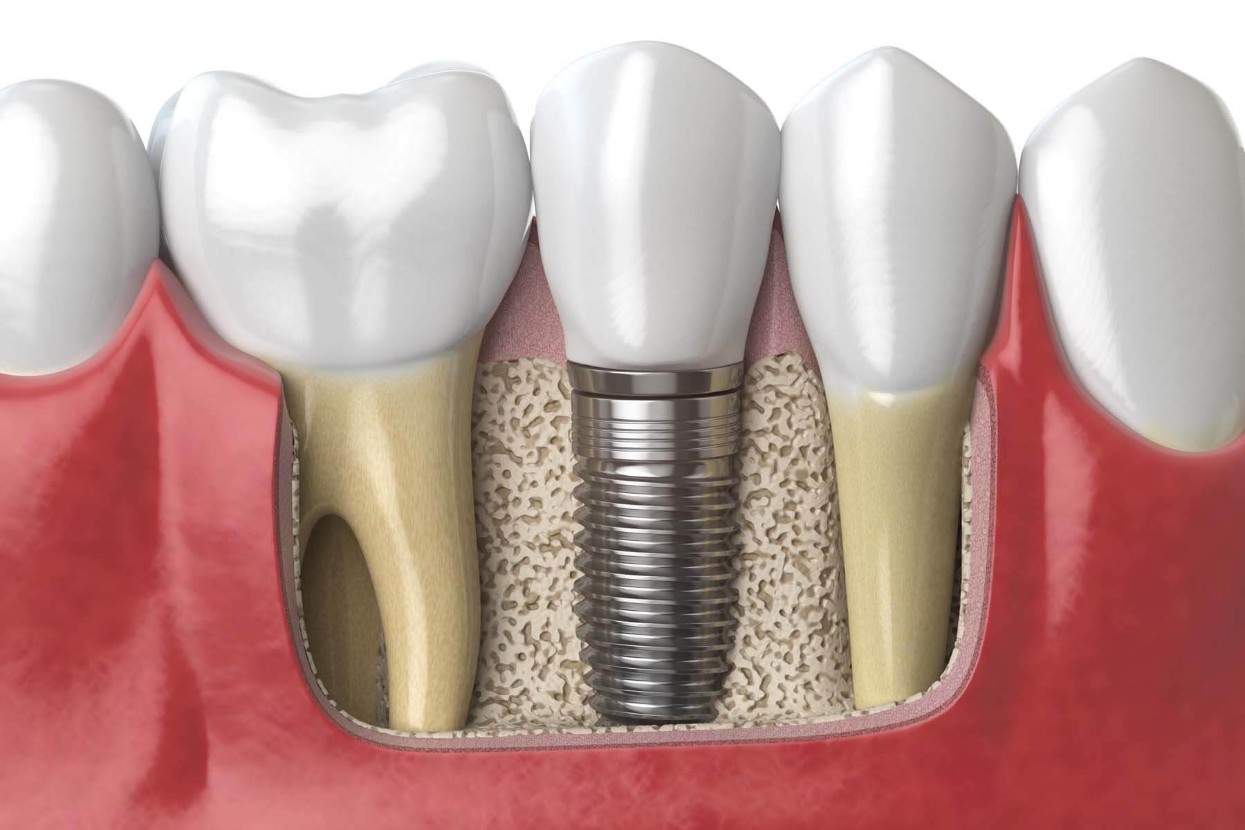 dental-implant-social-2