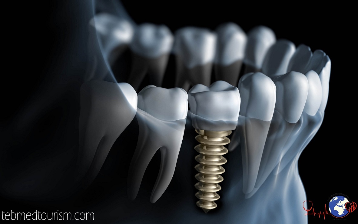 dental-implant