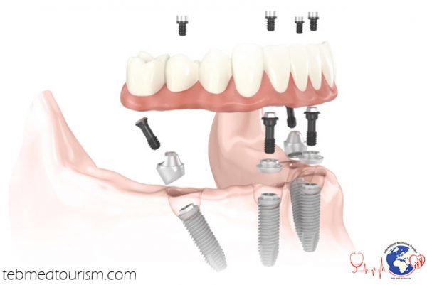 dental implants32 e1597231136153