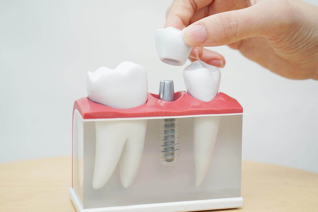 Dental Implant