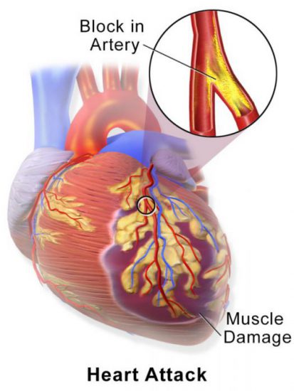 heart surgery