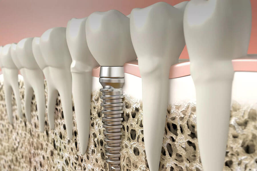 Dental Implant