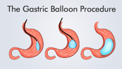 Bariatric Surgery in Iran , Weight Loss Surgery in Iran