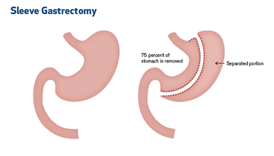 Bariatric Surgery in Iran , Weight Loss Surgery in Iran